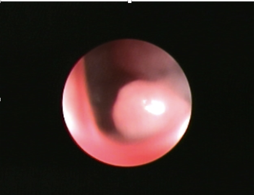 rhinoscopy nasal lymphoma